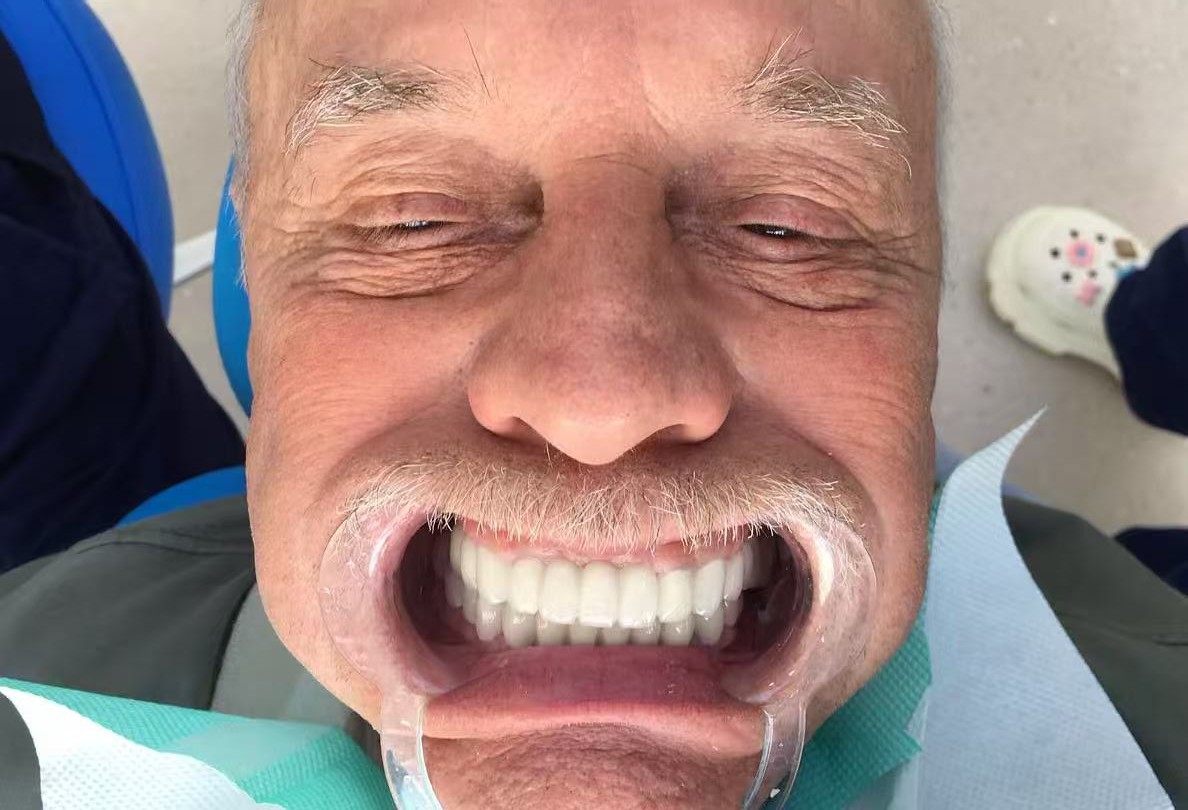 после протезирования зубов в Китае