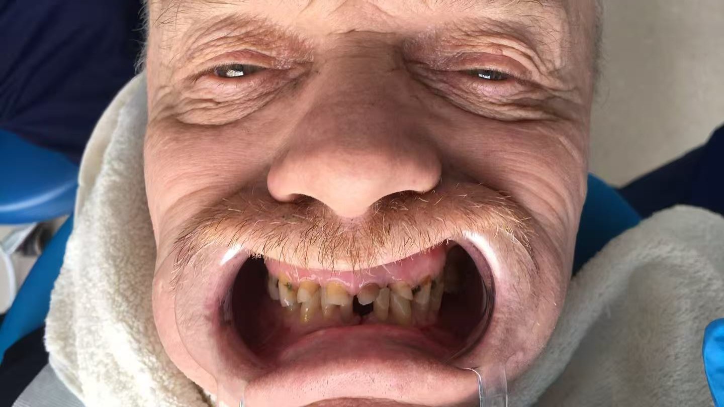 до протезировании зубов в Китае