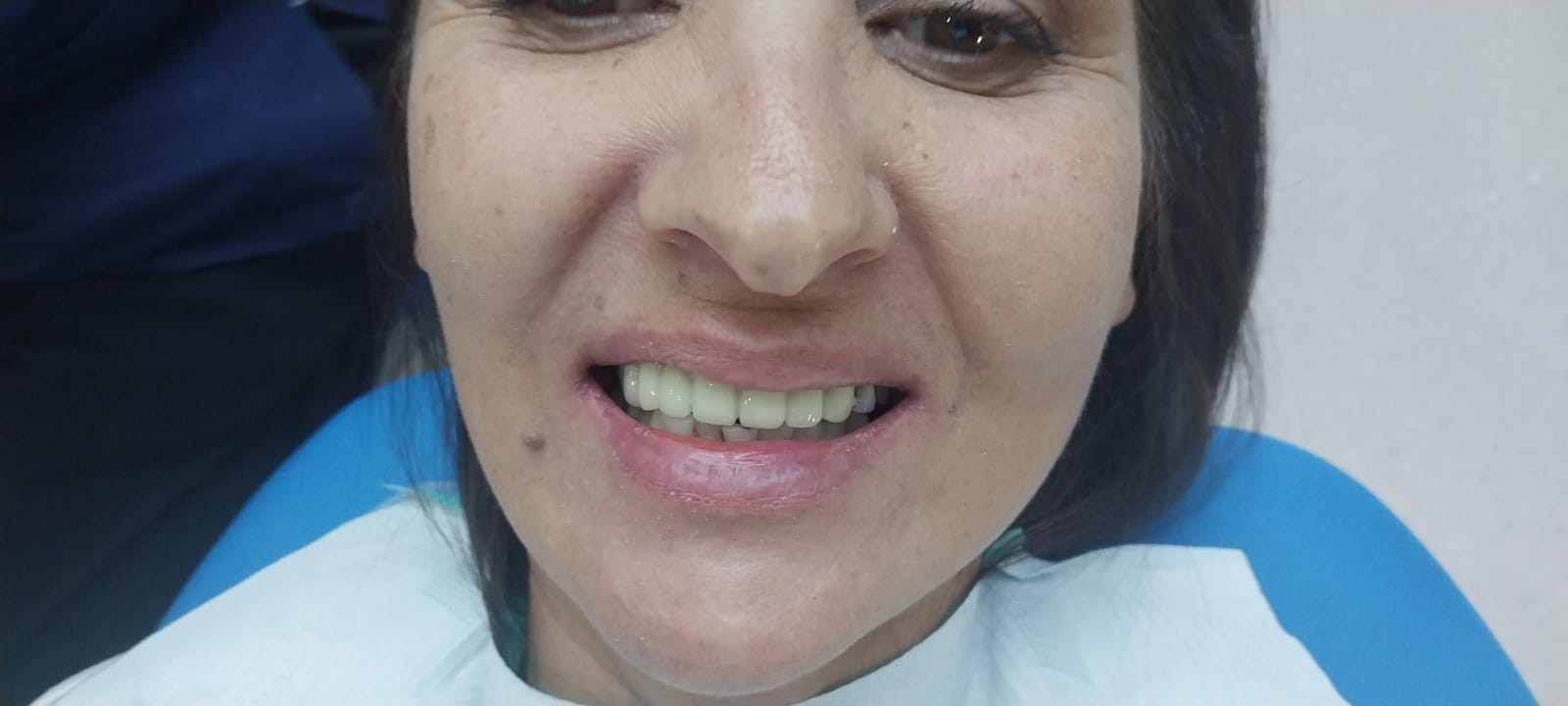 после протезирования зубов в Китае