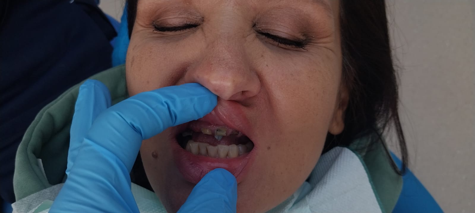 до протезировании зубов в Китае