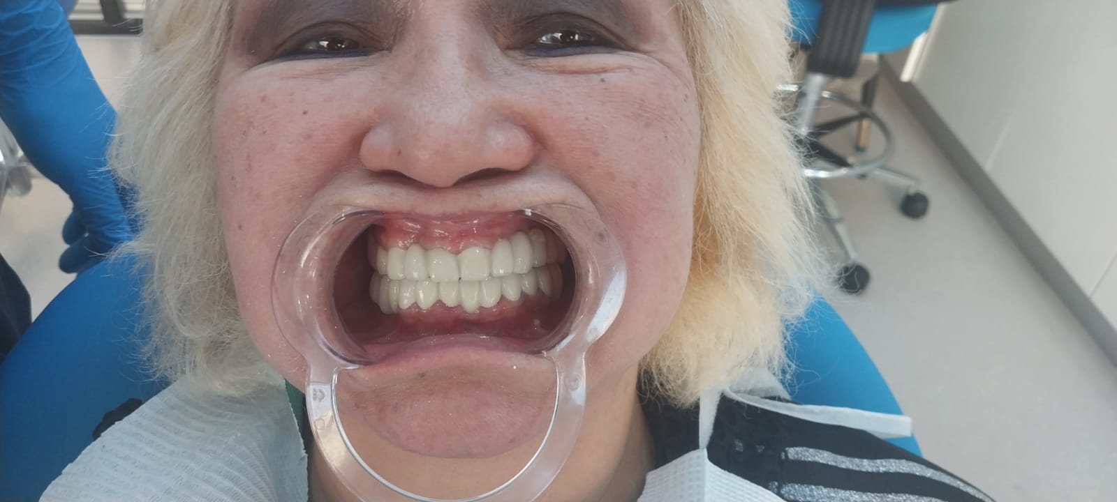 после протезирования зубов в Китае