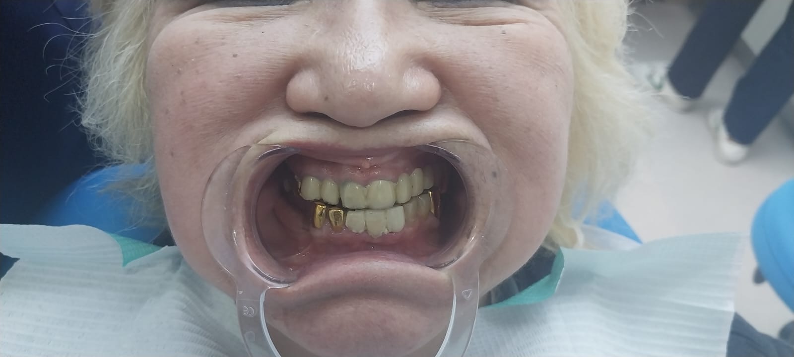 до протезировании зубов в Китае