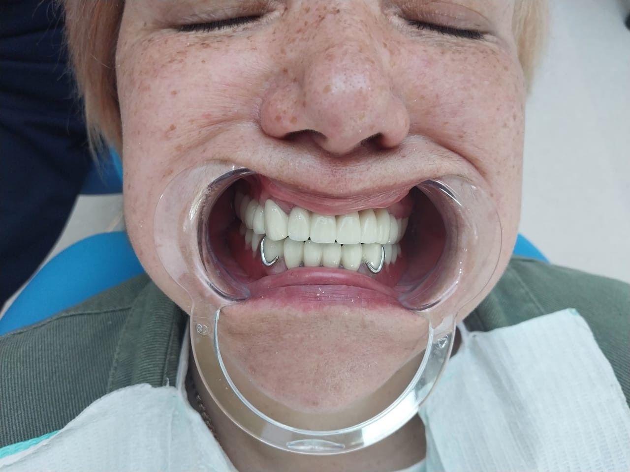 после протезирования зубов в Китае