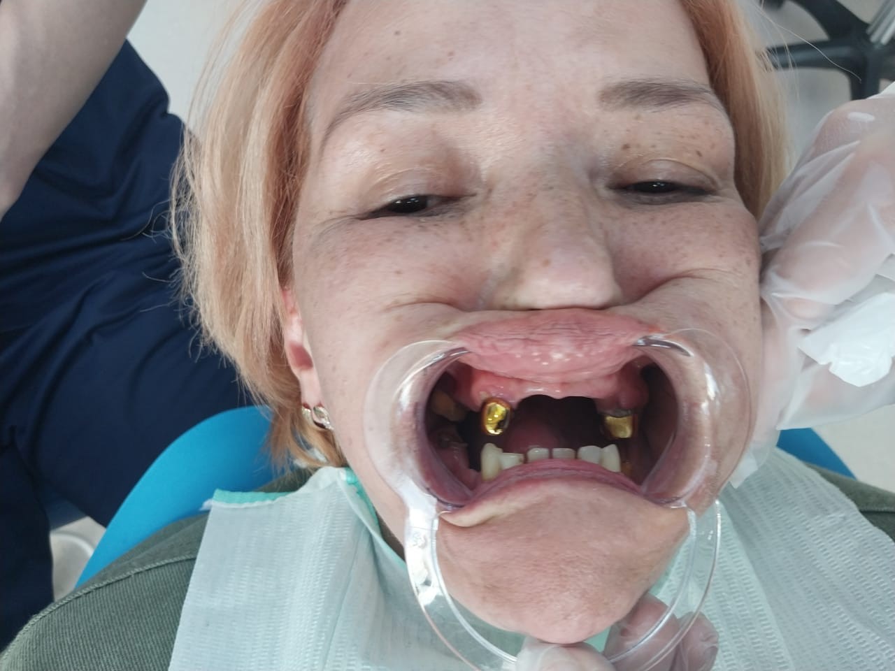 до протезировании зубов в Китае