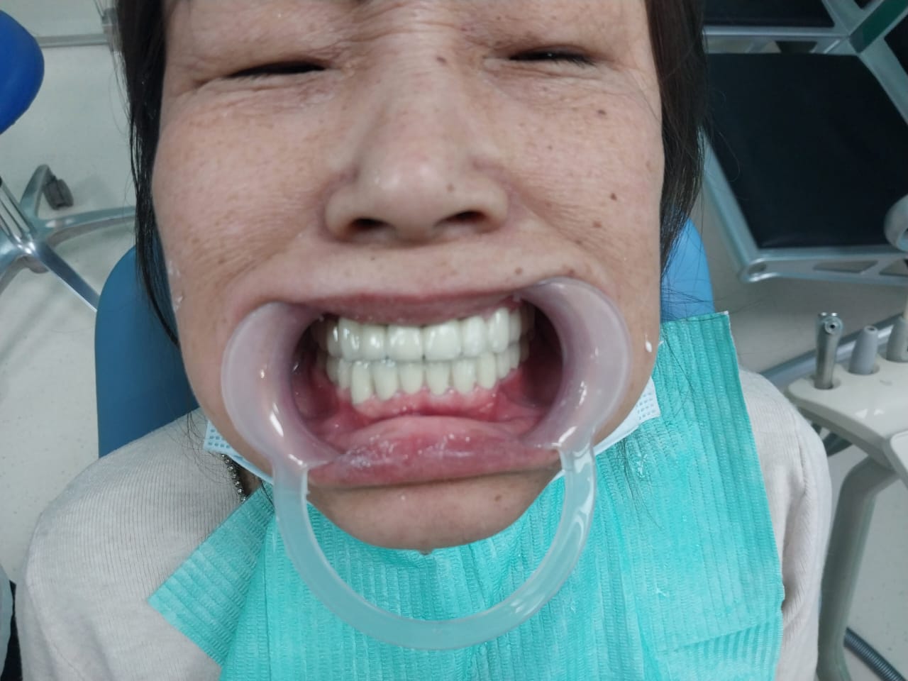 после протезирования зубов в Китае