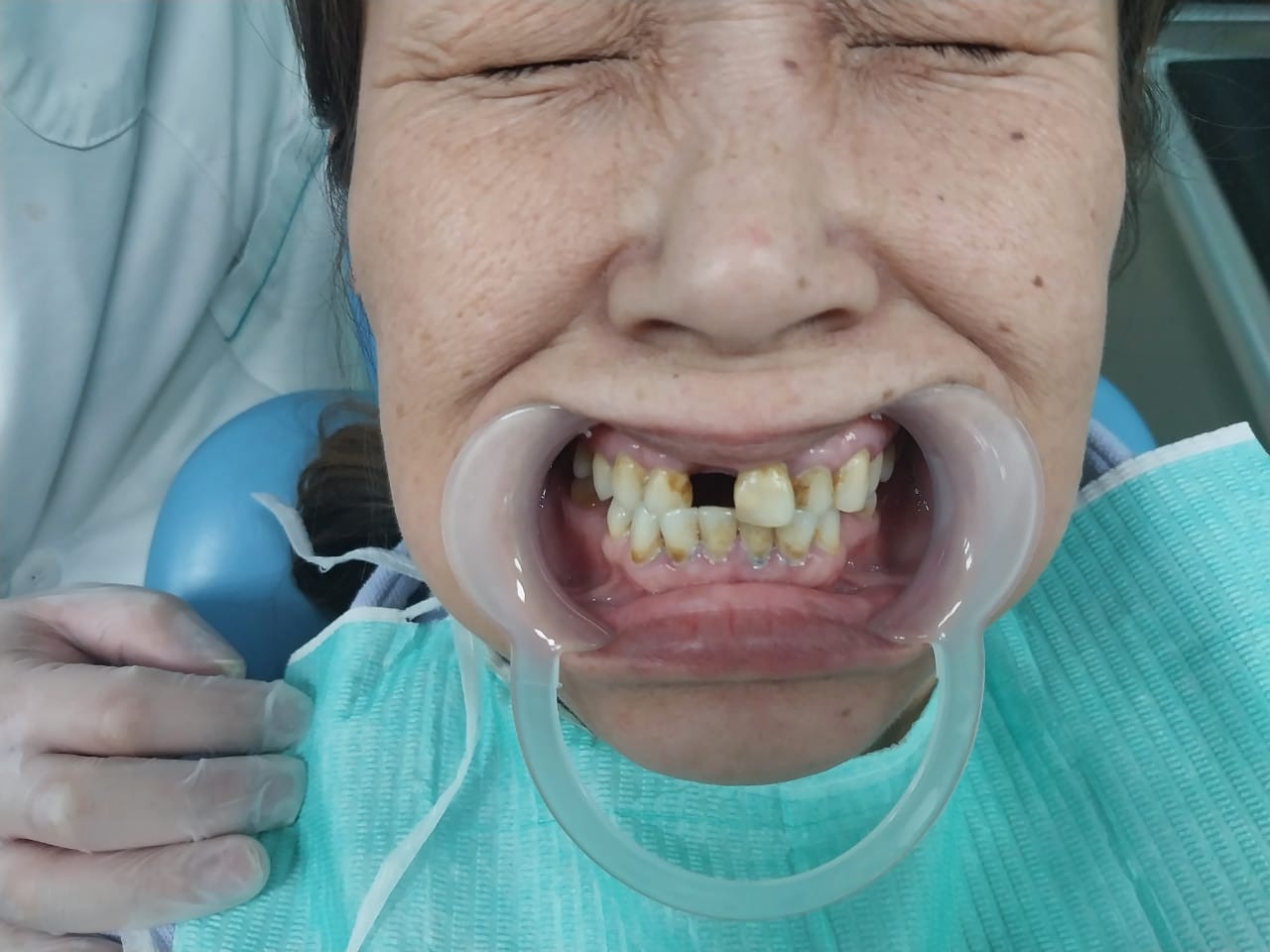 до протезировании зубов в Китае