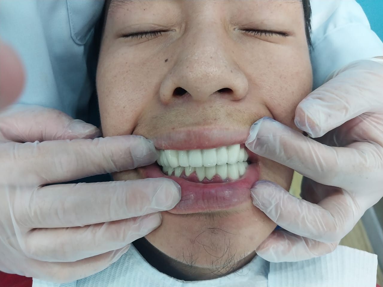 после протезирования зубов в Китае