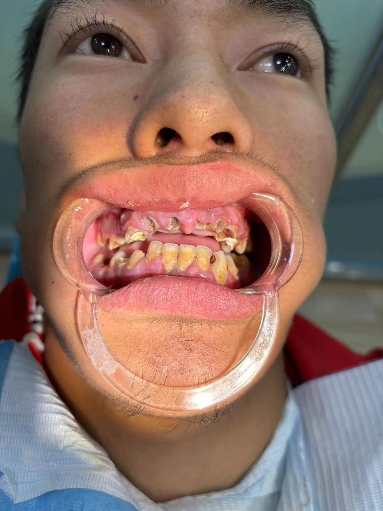 до протезировании зубов в Китае