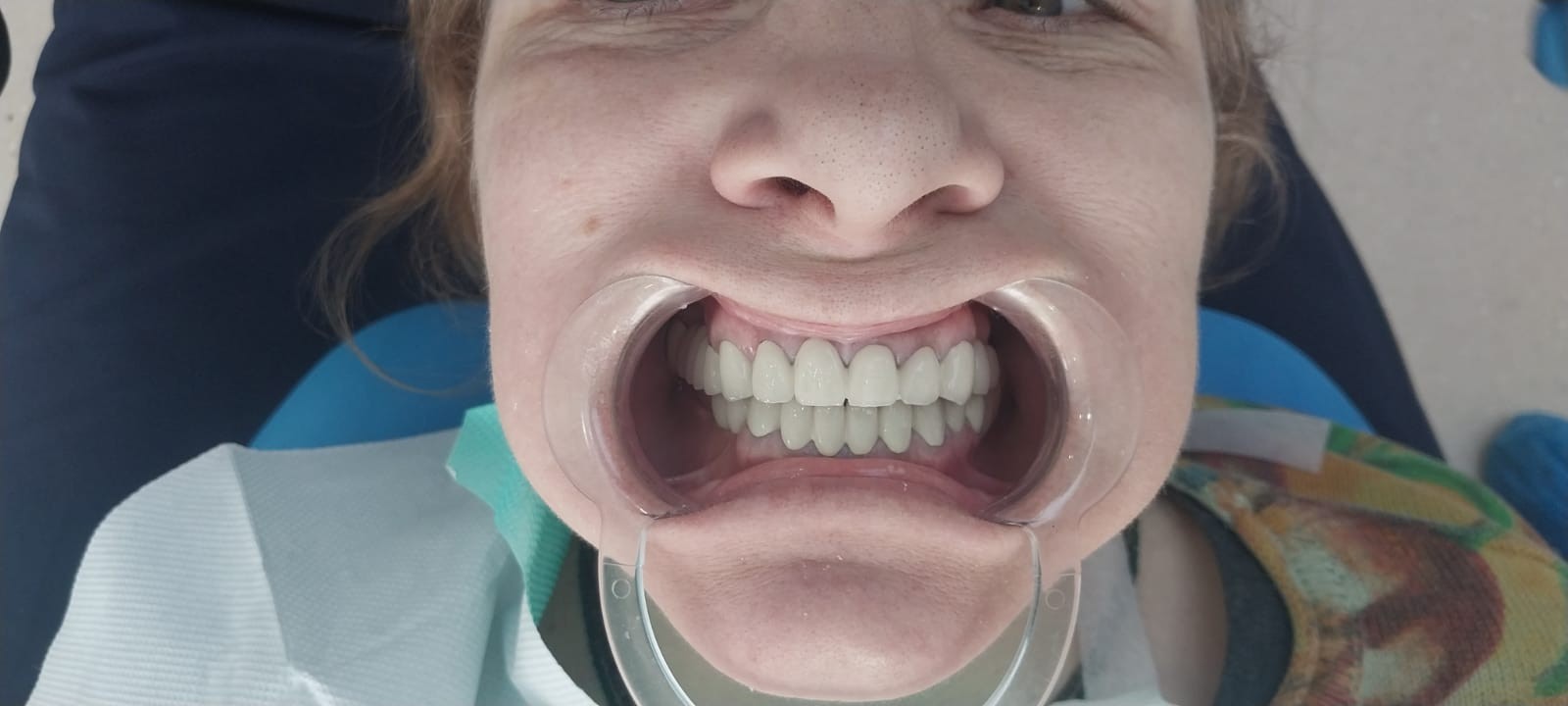 после протезирования зубов в Китае