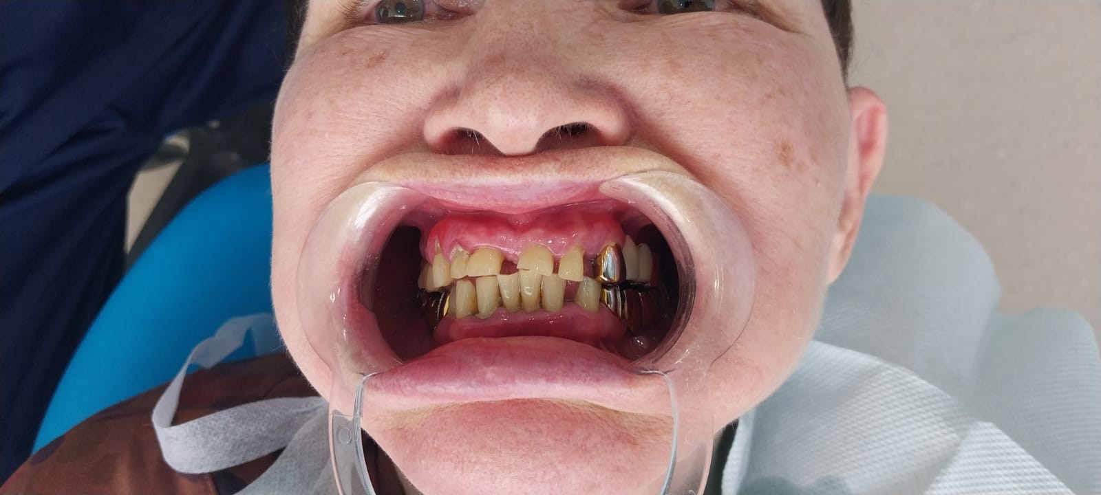 до протезировании зубов в Китае