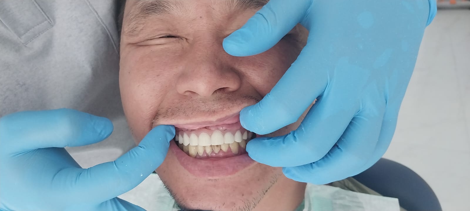 после протезирования зубов в Китае