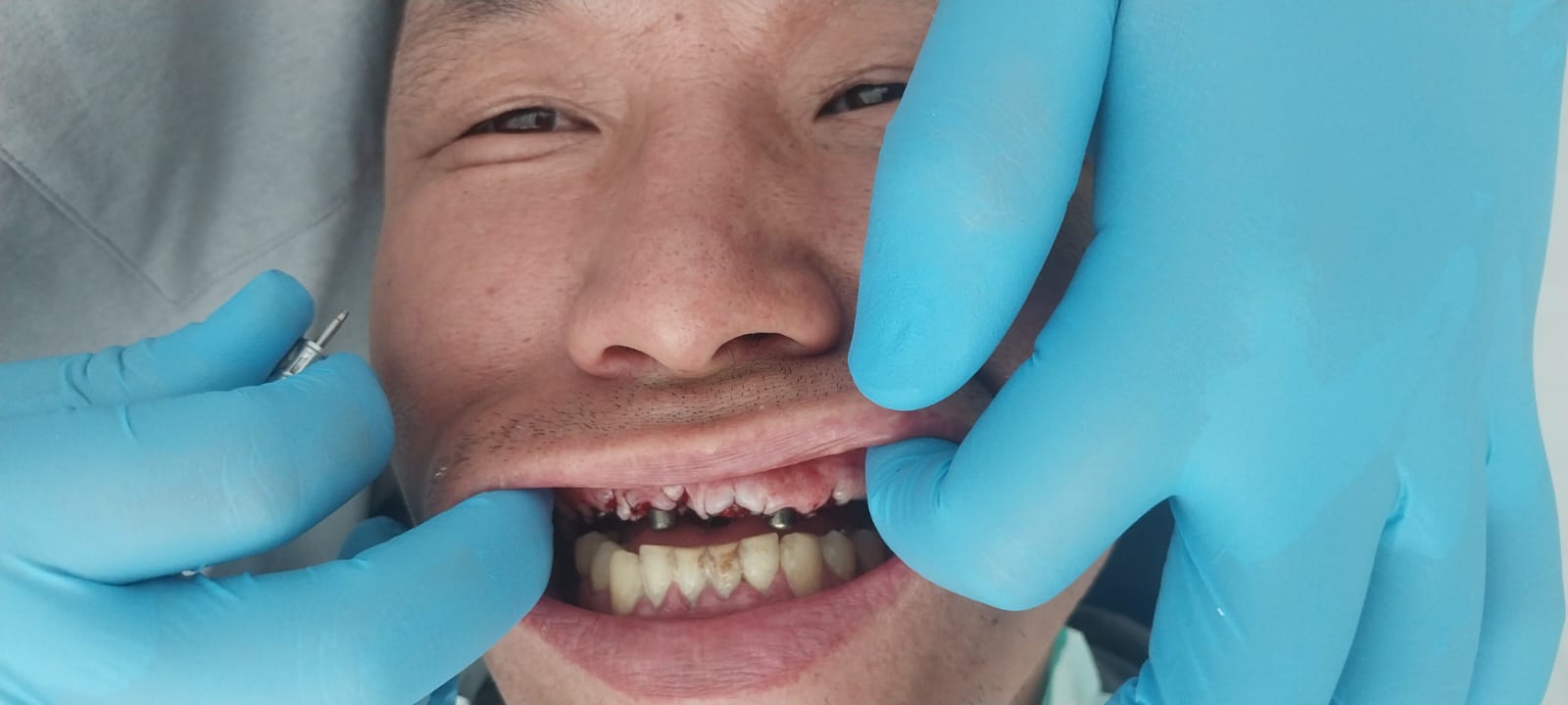 до протезировании зубов в Китае