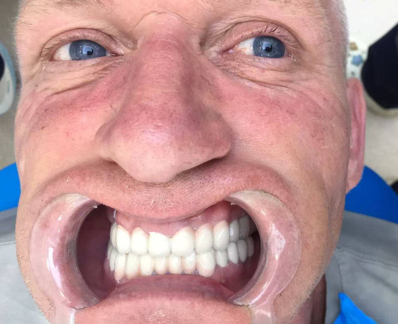 после протезирования зубов в Китае