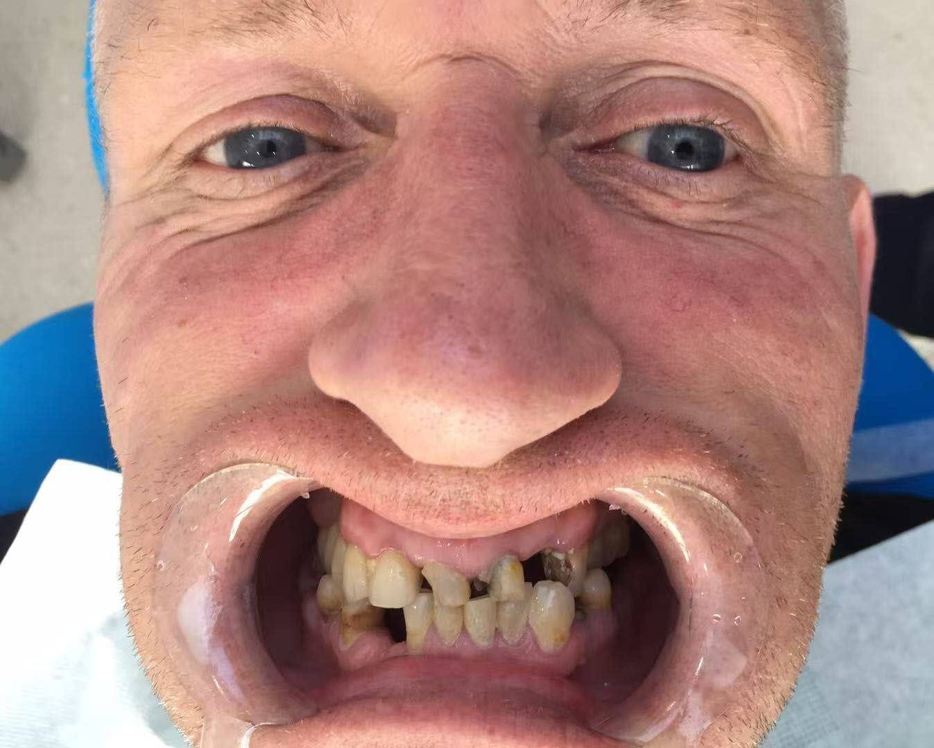 до протезировании зубов в Китае