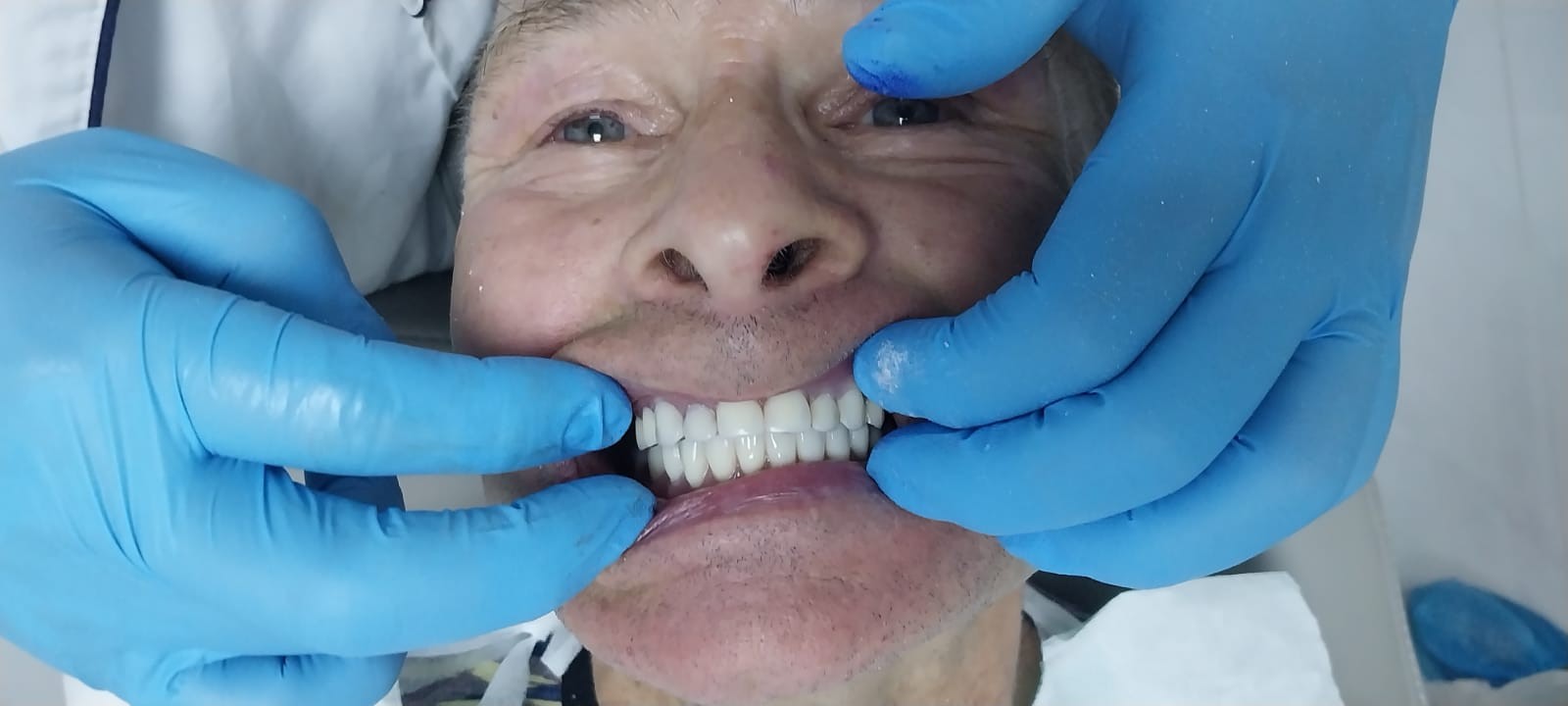 после протезирования зубов в Китае