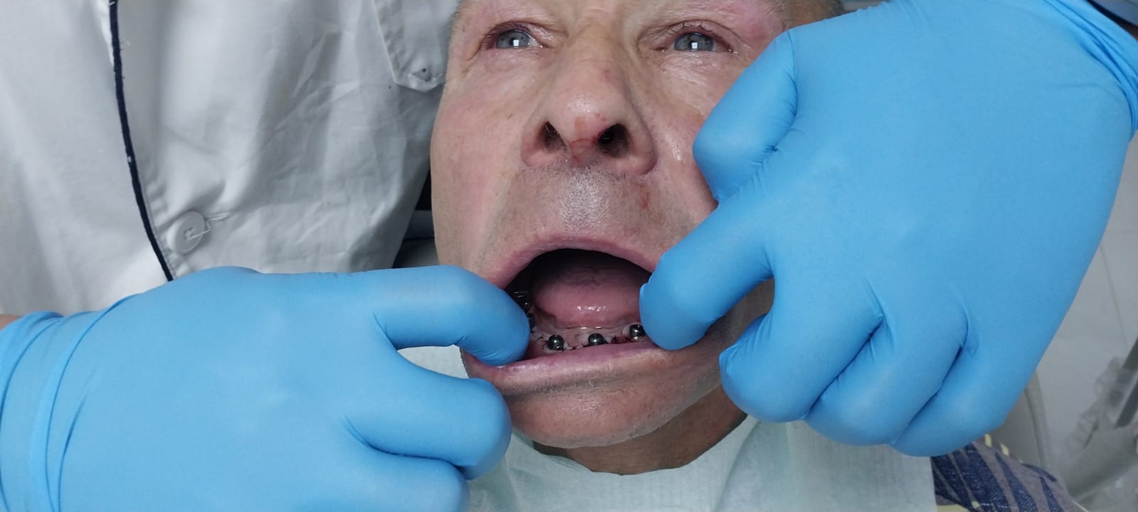 до протезировании зубов в Китае