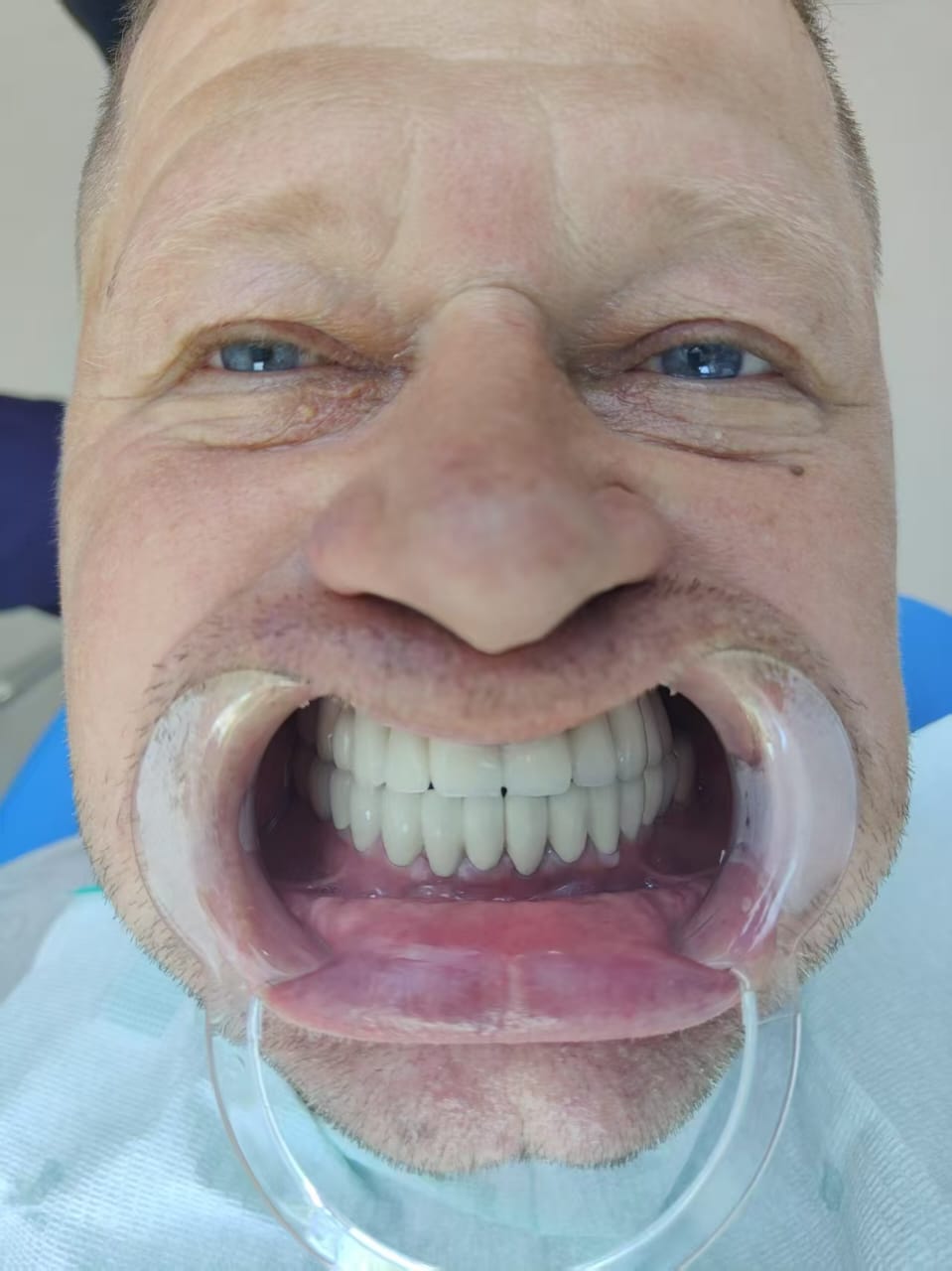 после протезирования зубов в Китае