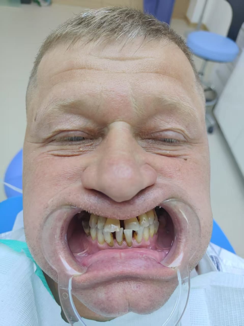 до протезировании зубов в Китае