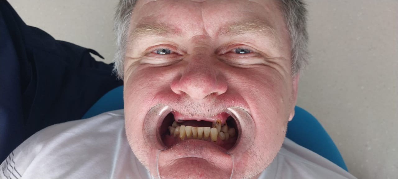 до протезировании зубов в Китае